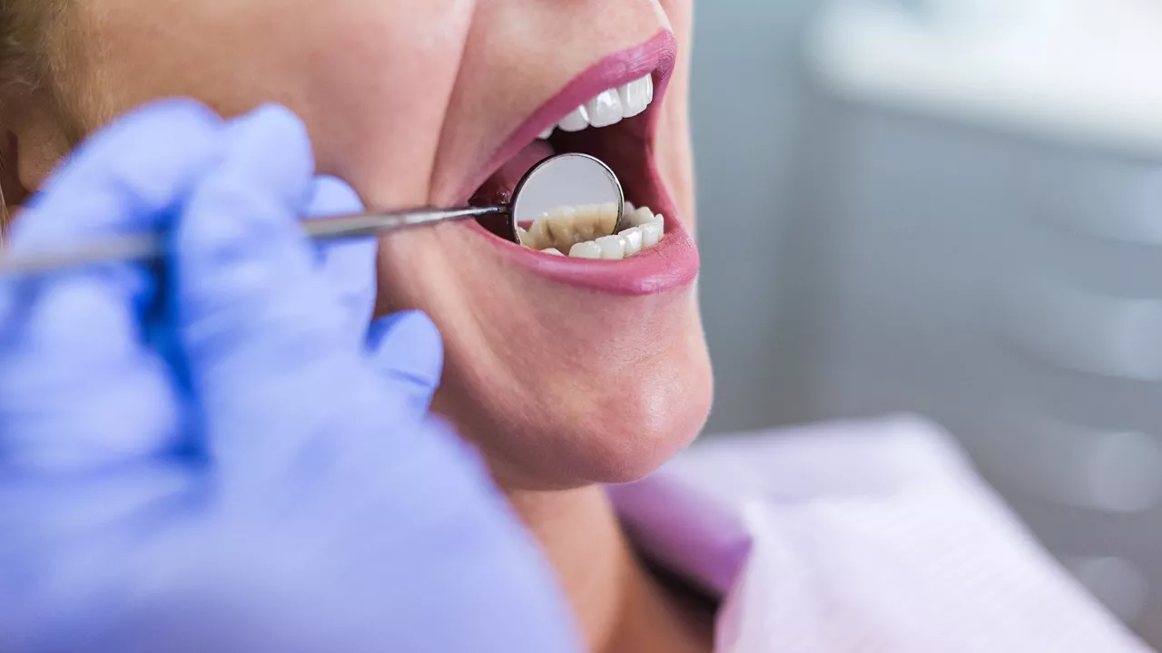 parodontiitti: mihin se voi hoitamattomana johtaa?