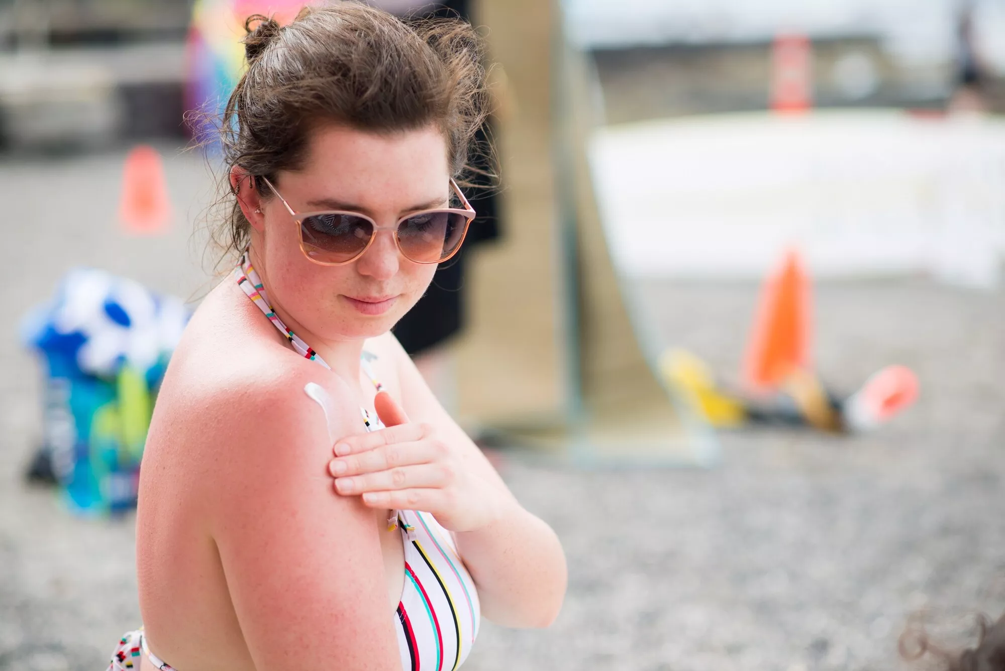 nainen levittää aurinkorasvaa, kun ihon palaminen on päässyt jo tapahtumaan