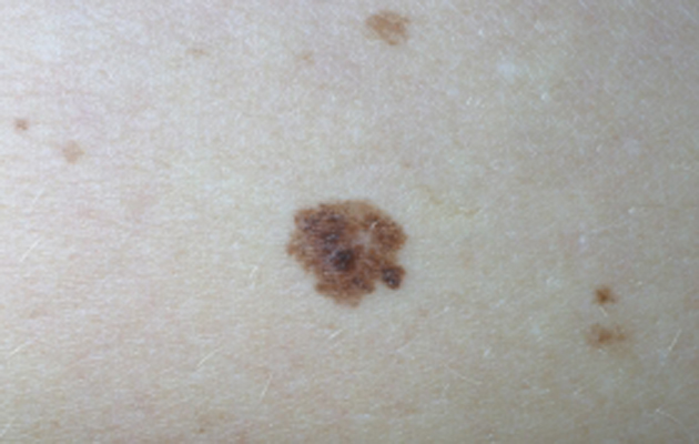 Ihosyöpä: kuva melanoomasta