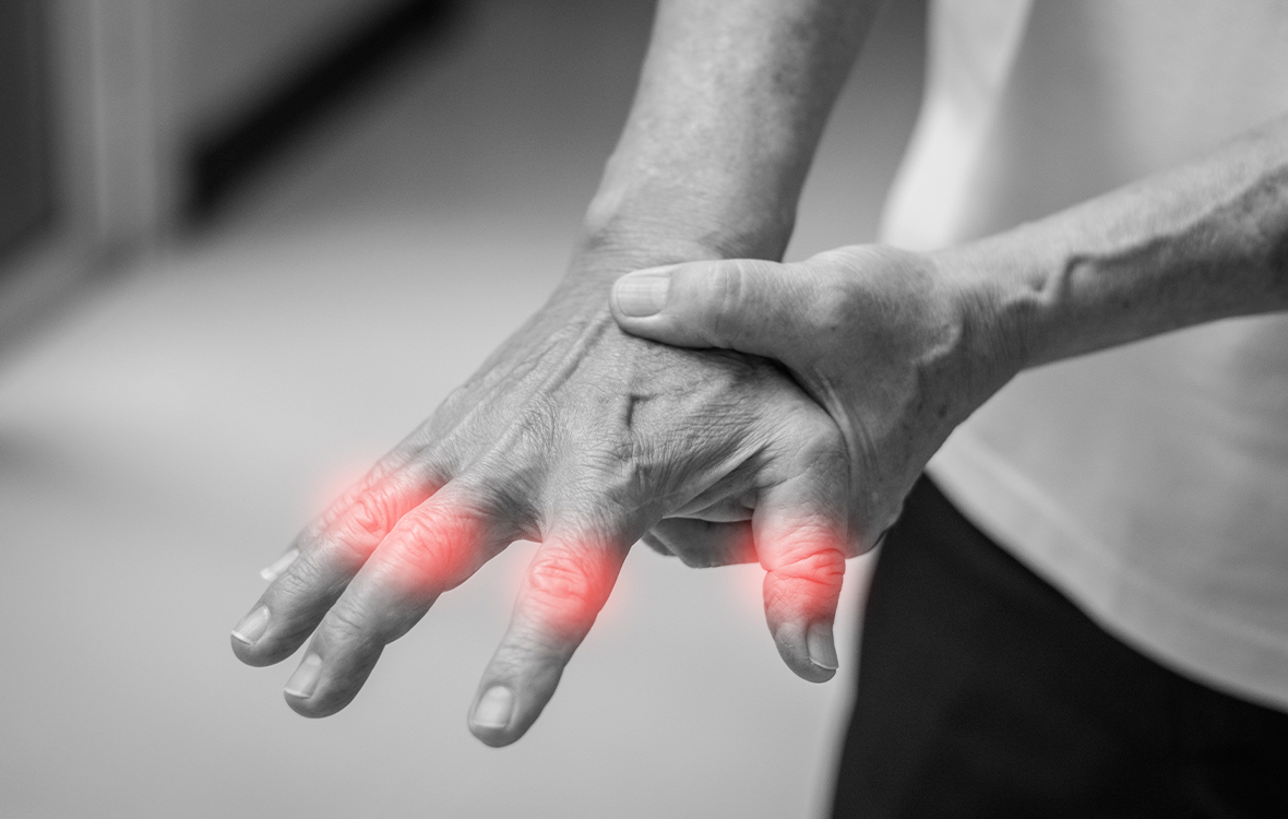 Nivelrikko sormissa tuntuu usein turvotuksena, jäykkyytenä ja särkynä nivelissä.